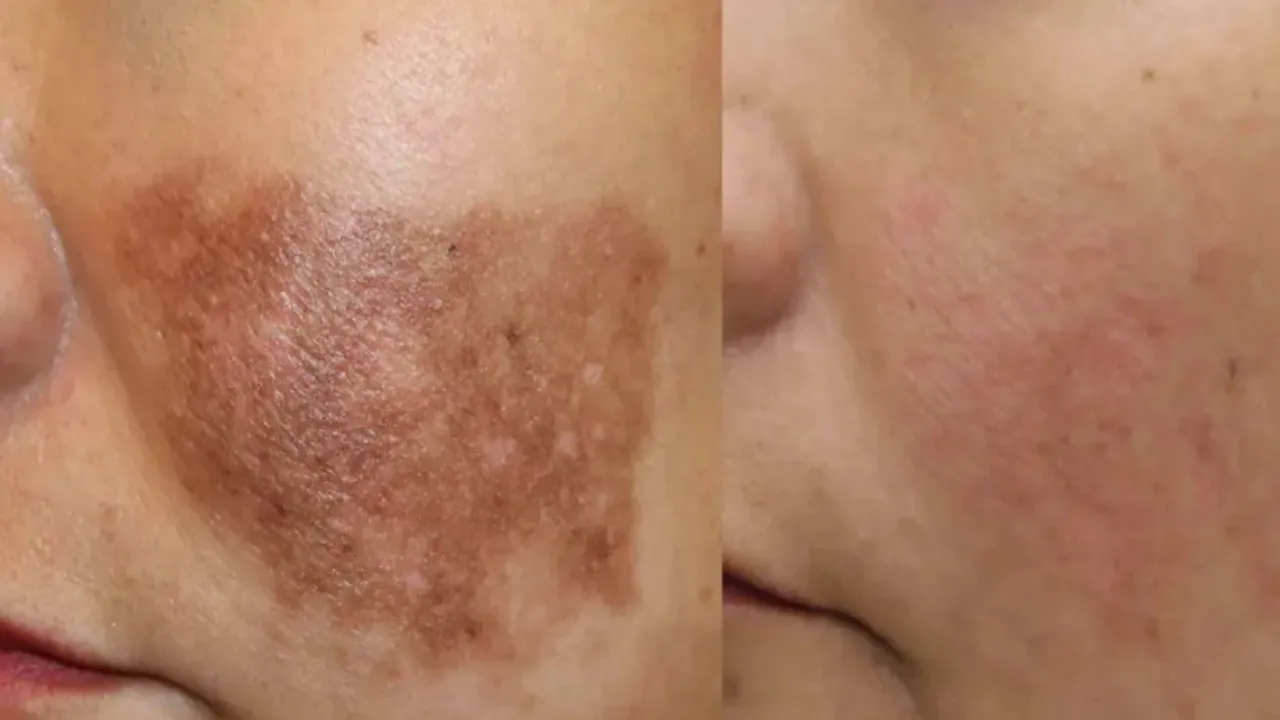 PIGMENTATION