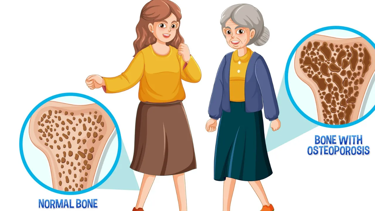 Osteoporosis