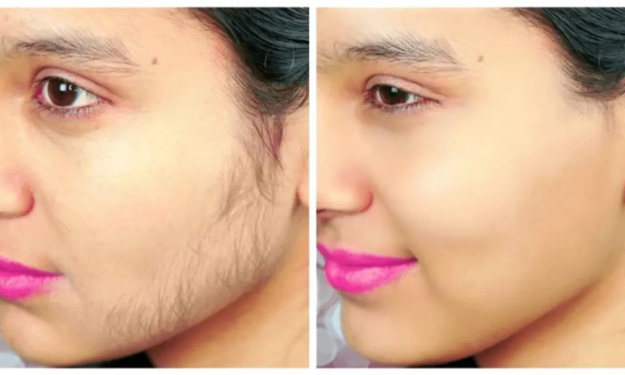 Follow These 5 Easy Methods To Remove Unwanted Hair From Face
