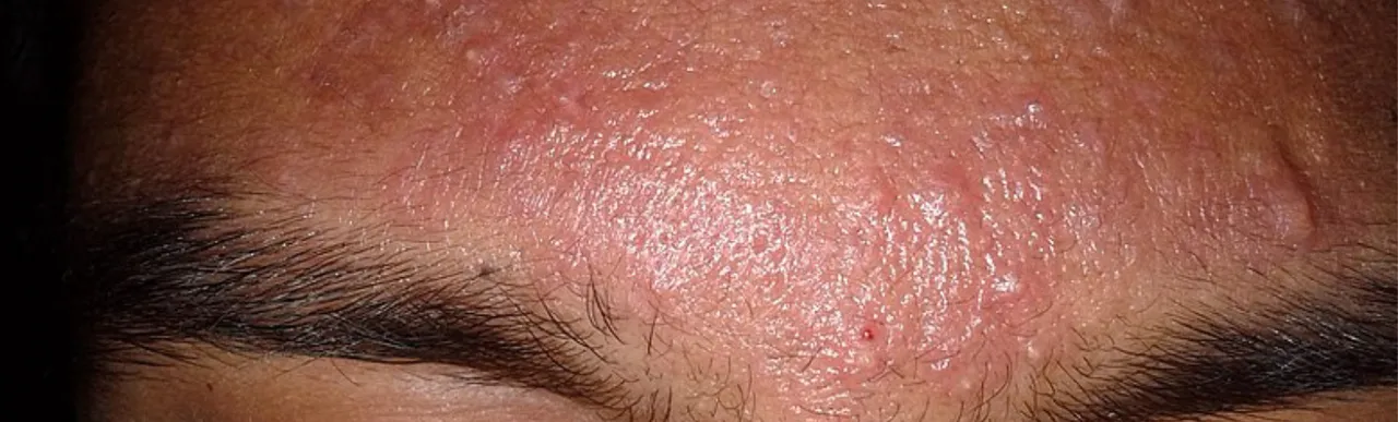 Pimples On Forehead : पिंपल्स हटाने के लिए जानिए घरेलू तरीके