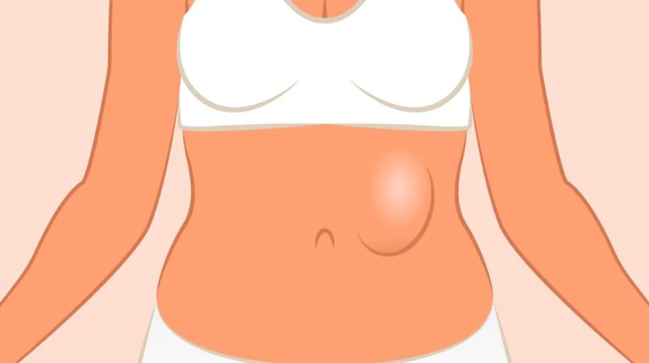 hernia in women