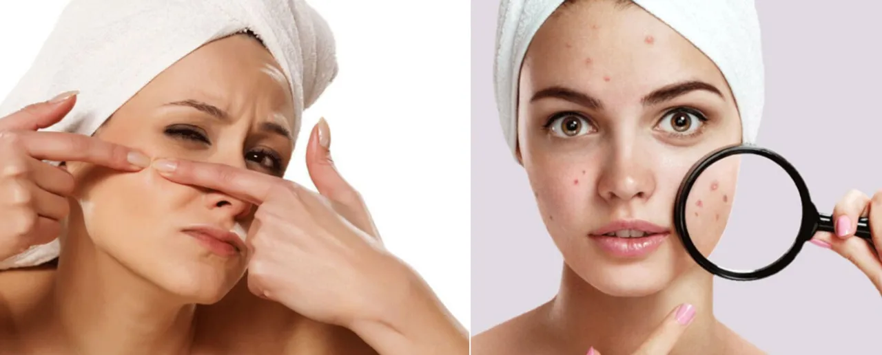 Reasons For Having Pimples: चेहरे पर पिम्पल्स होने के 5 कारण