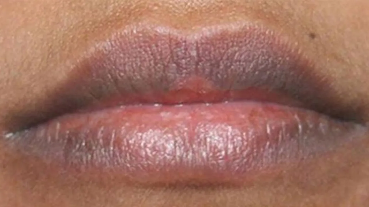 How To Reduce Lip Pigmentation 