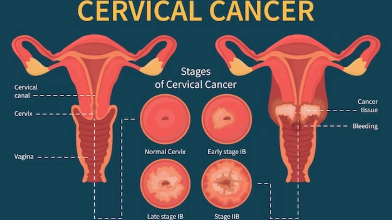 Cervical Cancer के शुरुआती लक्षणों को समझें: अवेयर रहें, हेल्दी रहें
