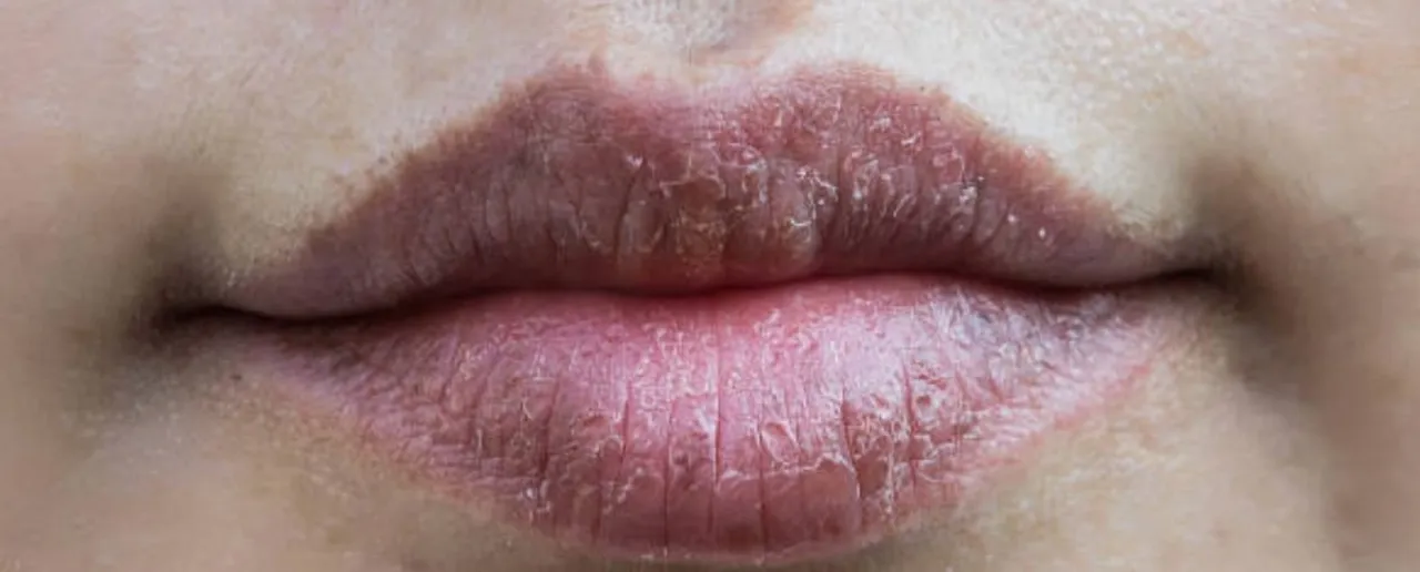 Tips To Heal Dry Lips