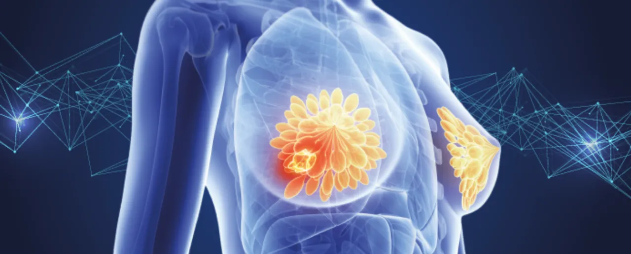 Breast Cancer : जानें ब्रेस्ट कैंसर की पहचान करने के 5 तरीके