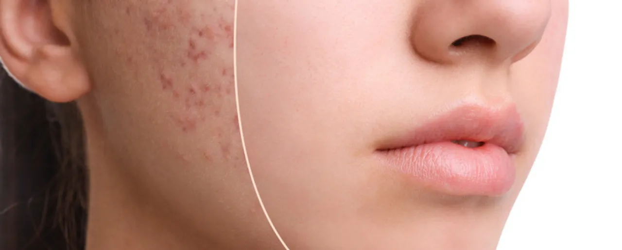 Acne And Pimples: गर्मियों में मुंहासों और फुंसियों से कैसे बचें