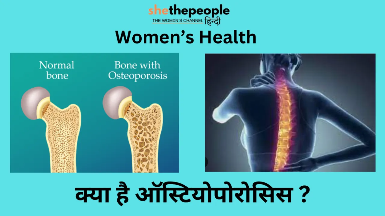 Women's Health: जानिए क्या है ऑस्टियोपोरोसिस? जिससे कई महिलाए होती हैं ग्रसित