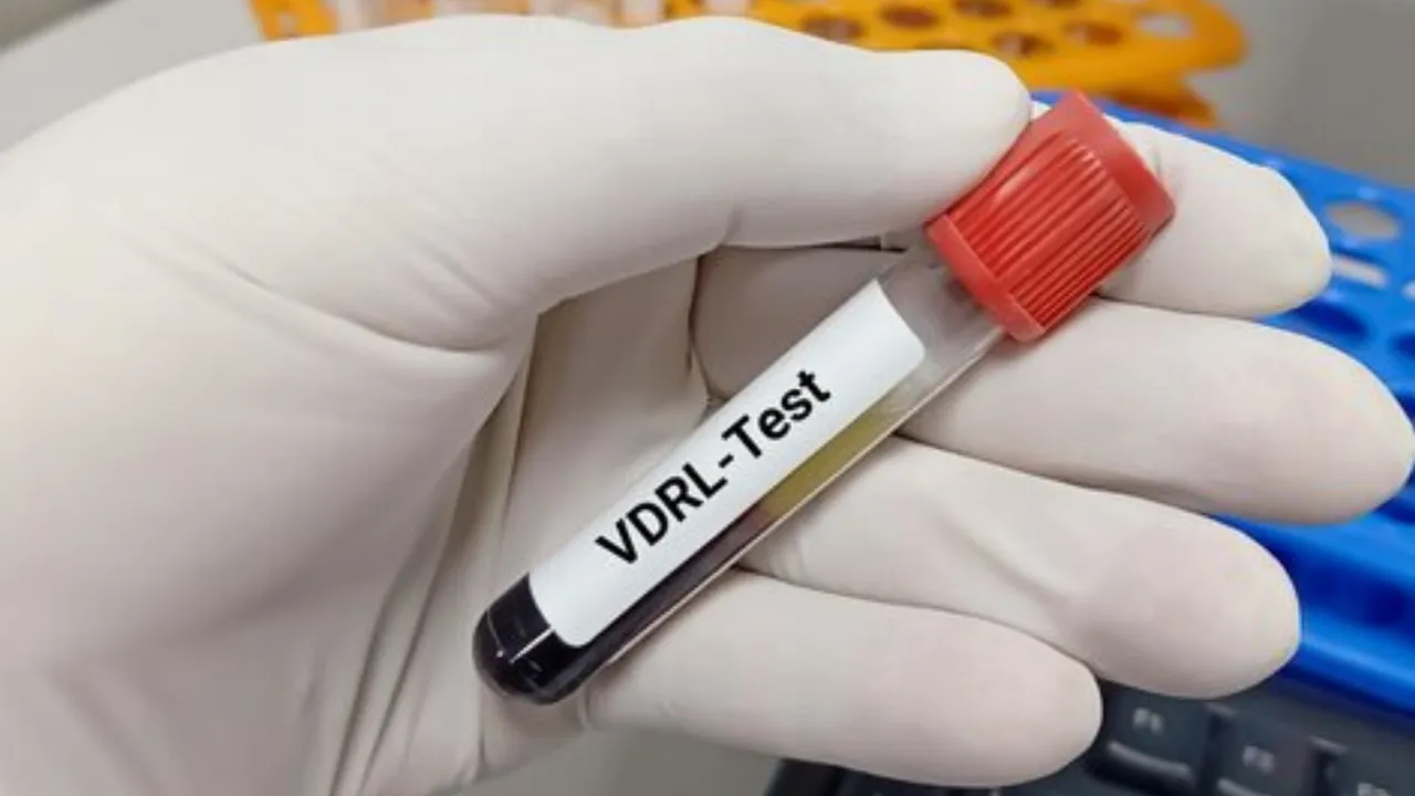 Prepare For VDRL Test: जानें इस टेस्ट से संबंधित सभी जरूरी बातें
