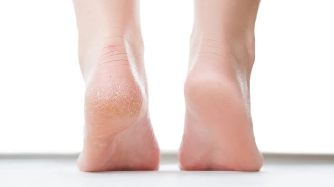 Remedies For Cracked Heels: फटी हुई एड़ियों के लिए 5 घरेलू उपाय