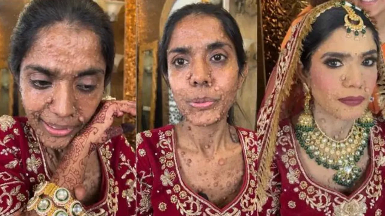 Bride With Skin Condition Shares Heartwarming Story Of Acceptance