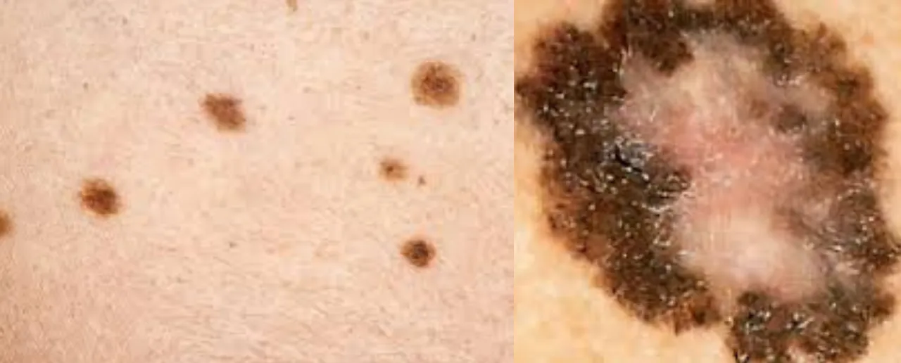 Skin Cancer: जानिए स्किन में कैंसर होने के क्या कारण हैं