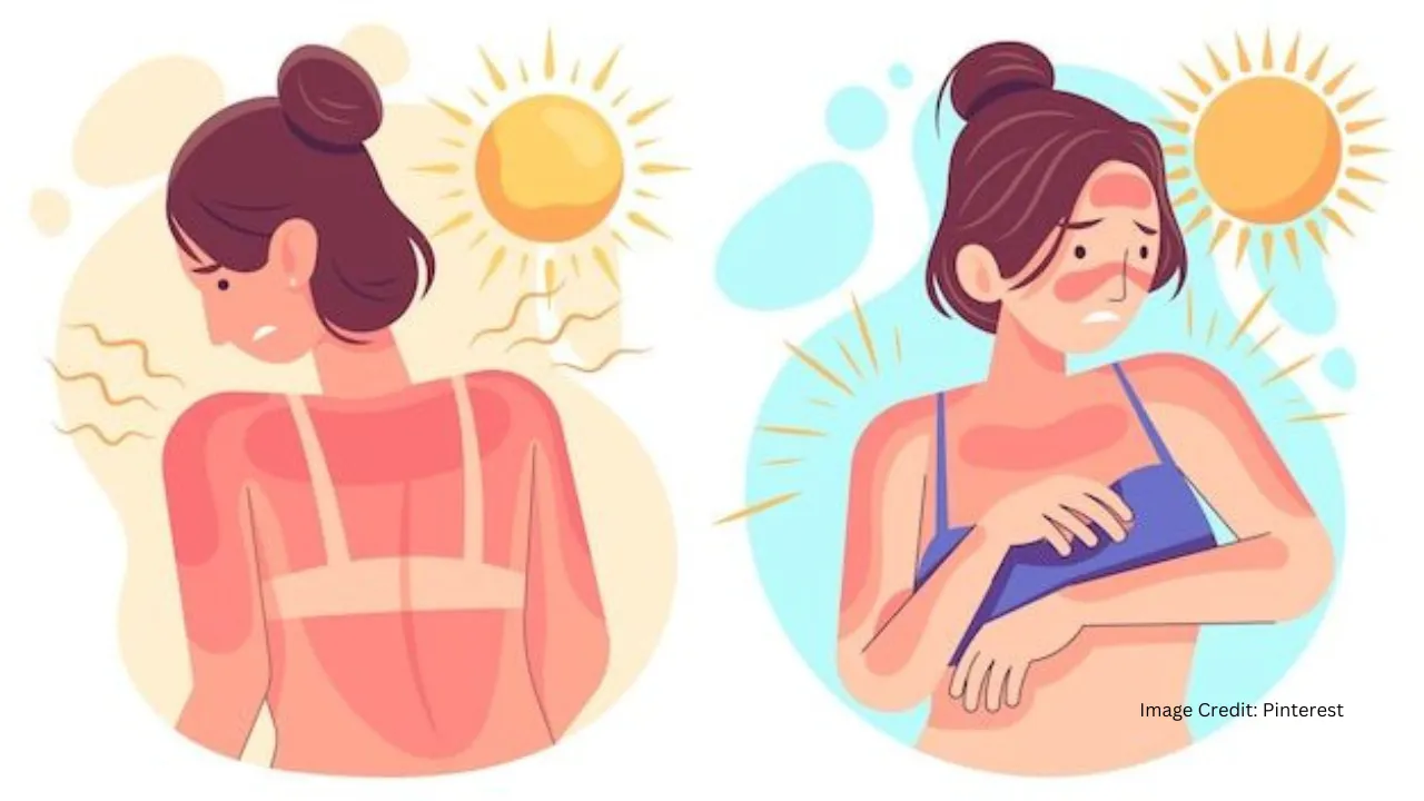 How To Treat Sunburn