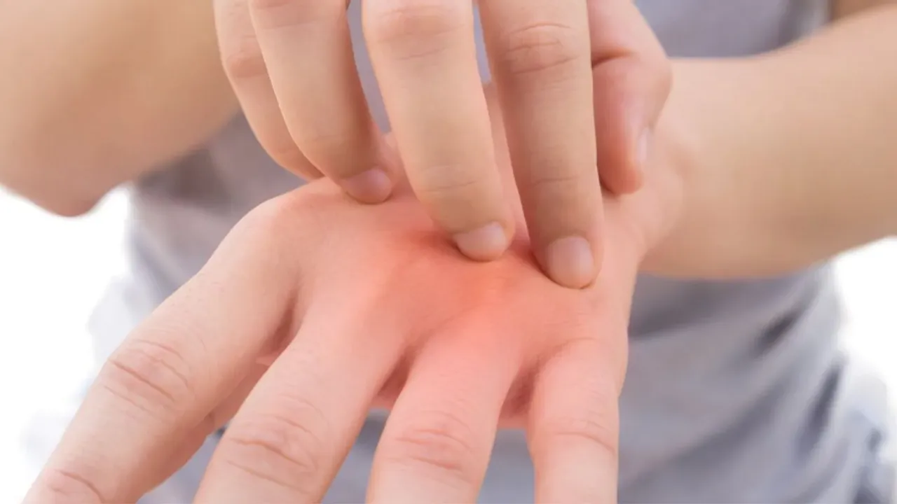 Chilblains: हाथ-पैर की उंगलियों में बढ़ती सूजन और ख़ुजली का उपचार