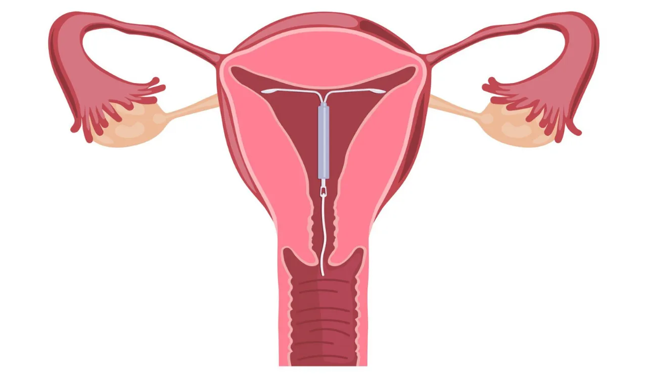 iud(GettyImages).png 