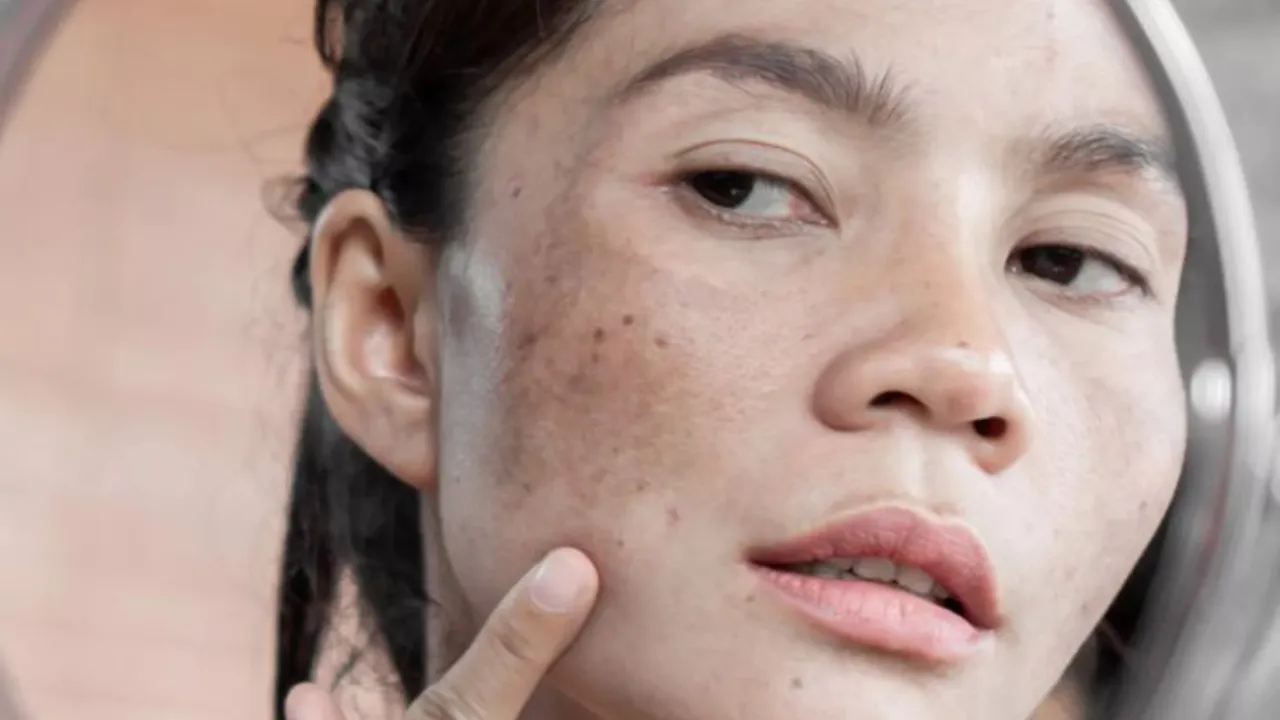 Home Remedies to Reduce Hyperpigmentation 