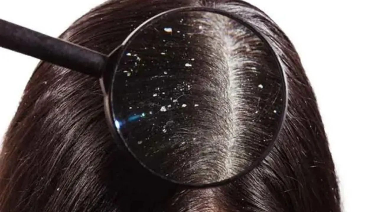 Hair Pack For Dandruff: ये हेयर मास्क डैंड्रफ को खत्म करे जड़ से