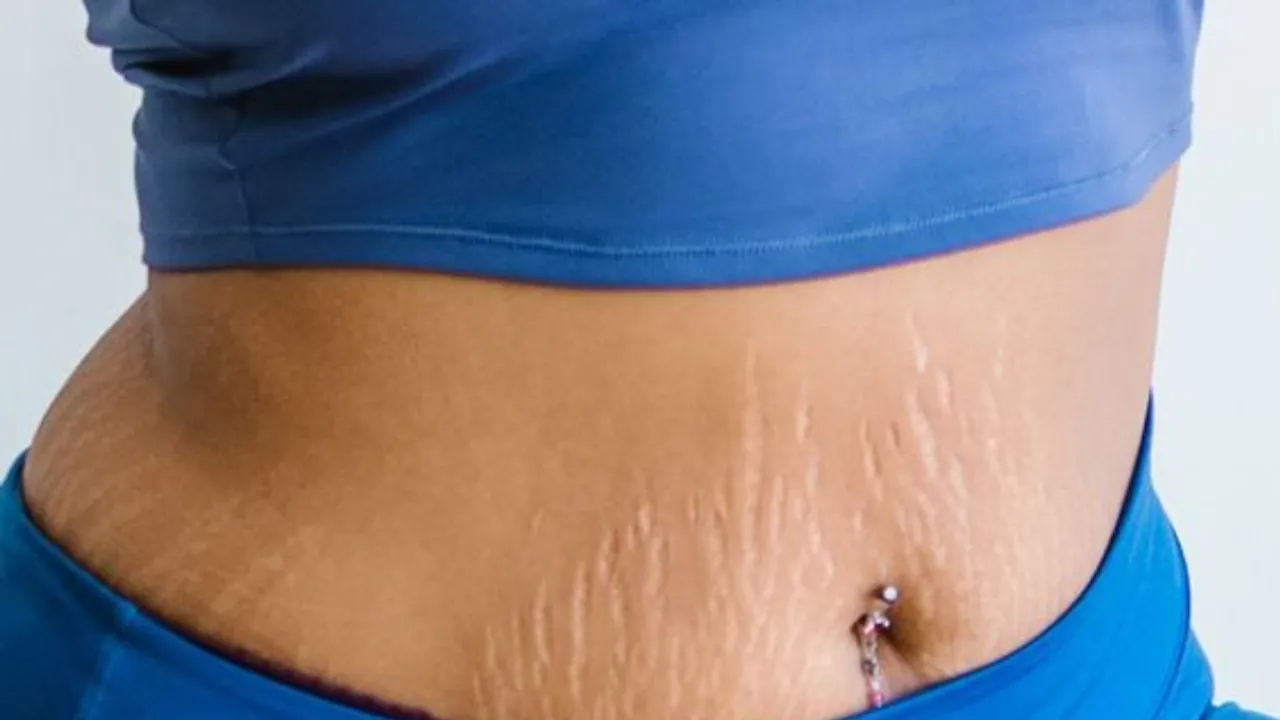 Stretch Marks (Pinterest).png