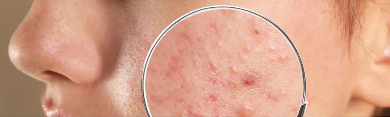 Acne: जानिए मुँहासे होने के 5 कारणों के बारे में