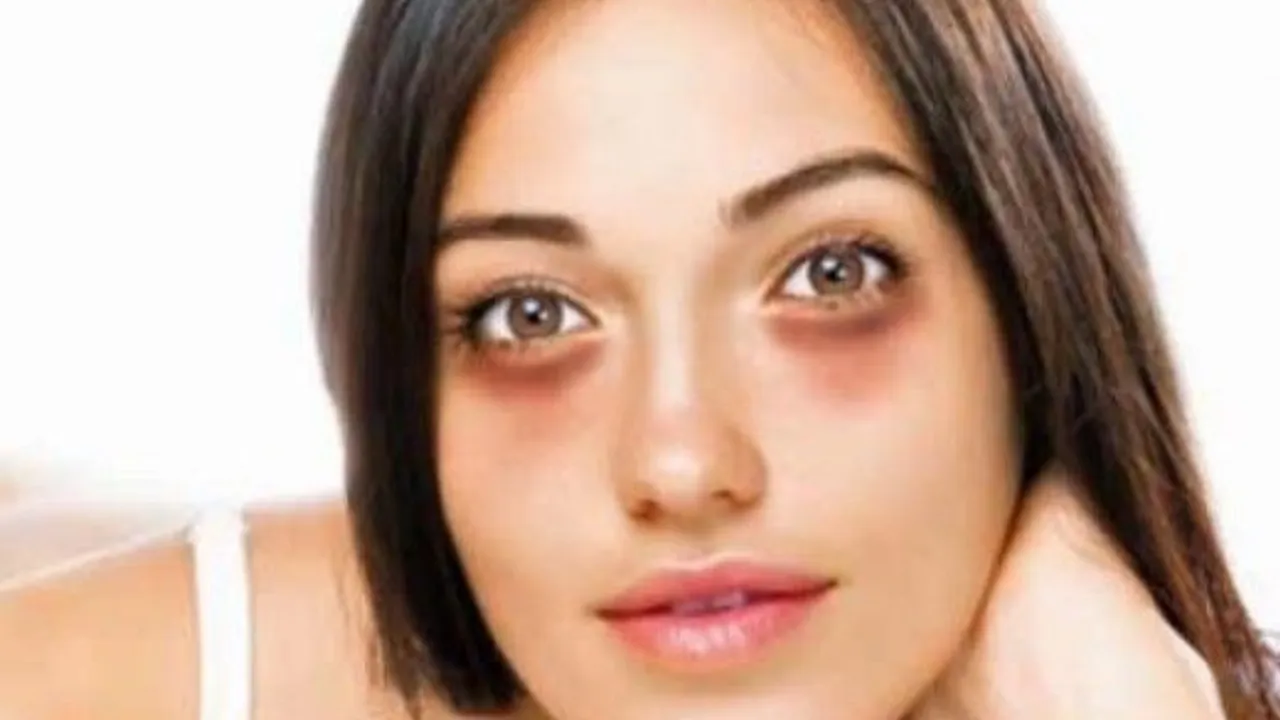 Dark Circles: डार्क सर्कल्स को कैसे ठीक कर सकते हैं?