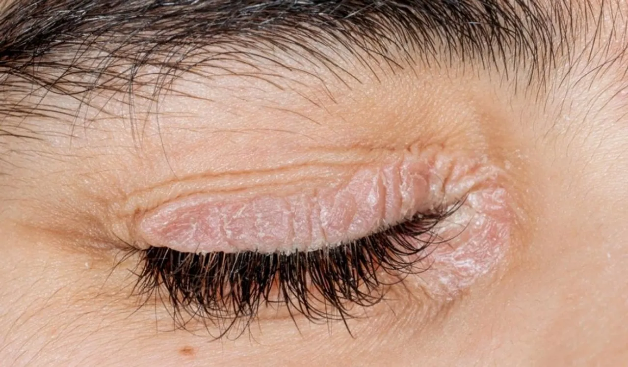Reason Behind Dry Eyelids: आंखों की पलकें सूखी क्यों लगती है? आइए जानते हैं