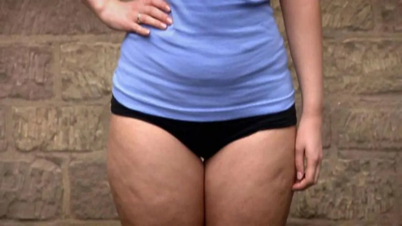 What is Lipedema: শরীরের নিচের অংশে ফ্যাট বৃদ্ধি লিপিডেমা রোগের ইঙ্গিত হতে পারে
