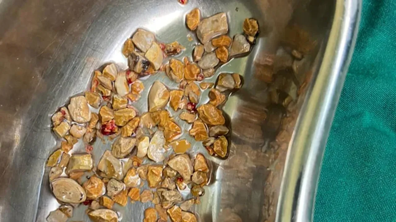 Doctors remove 206 kidney stones in 1 hour