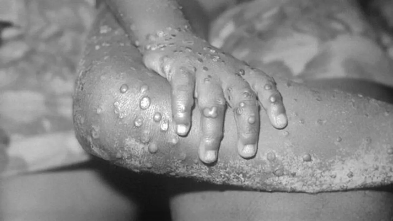 west bengal health dept issues guideline for monkeypox