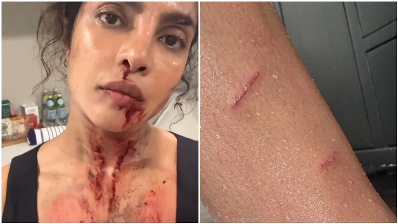 Priyanka Chopra hurt herself during shooting