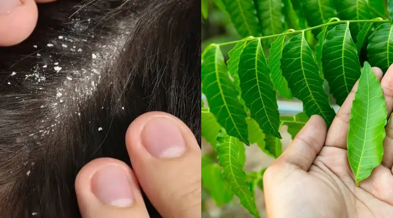 Neem and dandruff