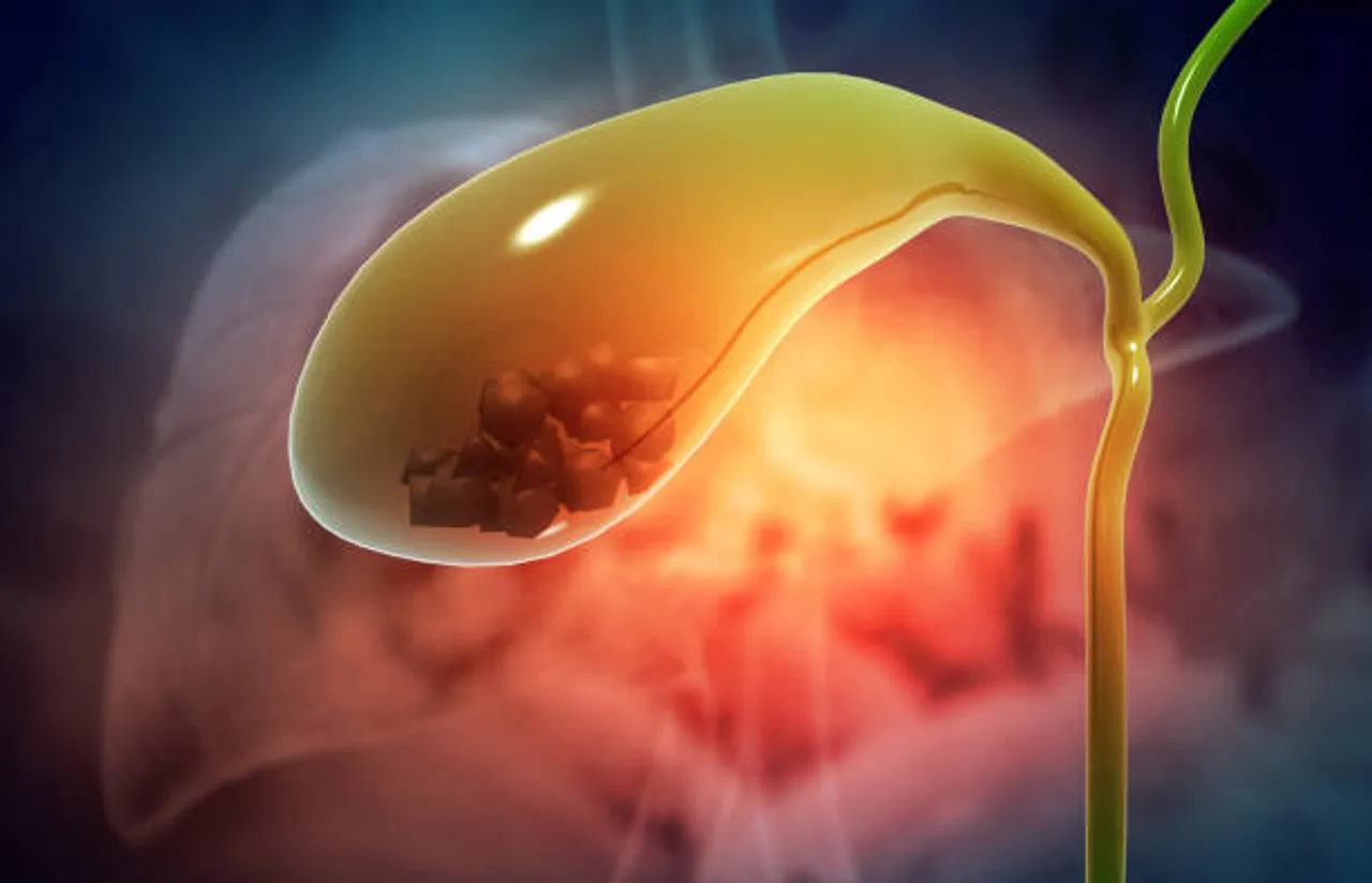 gallstones