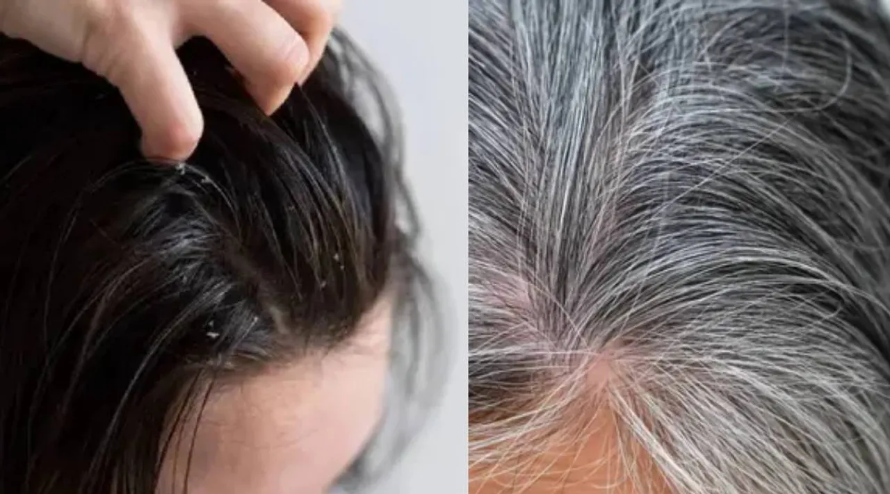 Dandruff and Grey hair