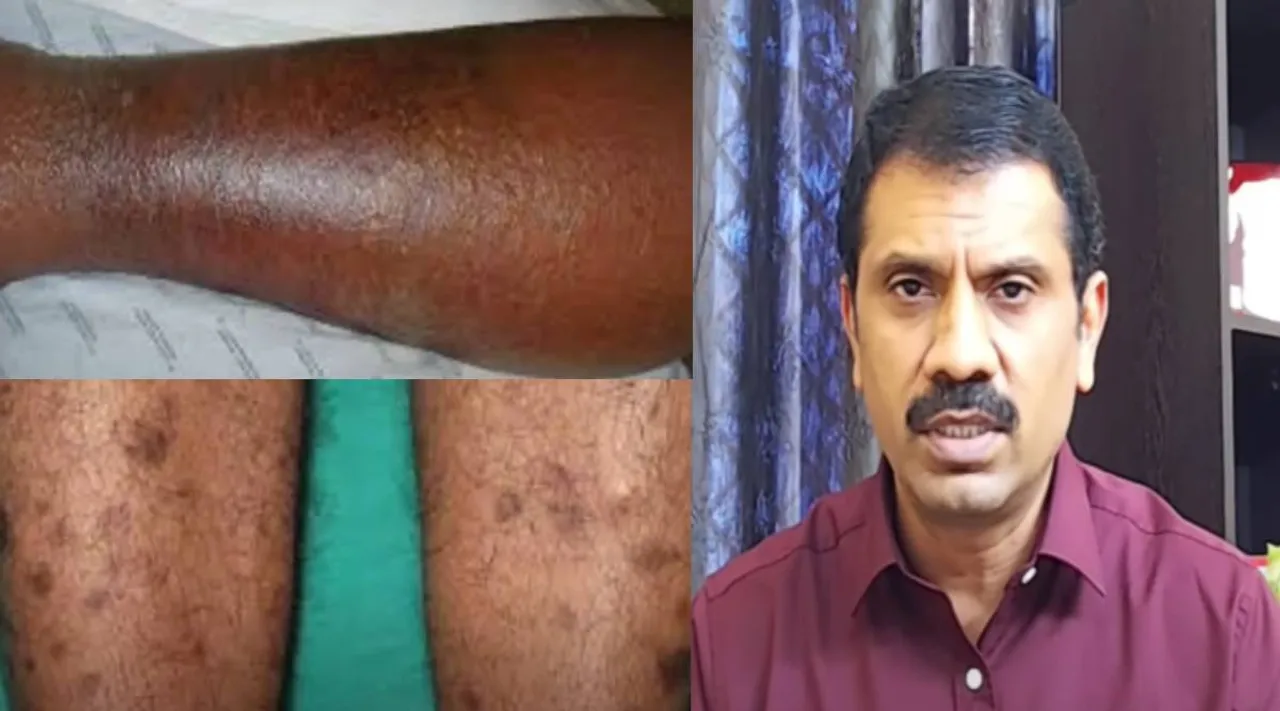 TOP REASONS FOR BLACKENING OF LEGS |TREATMENT