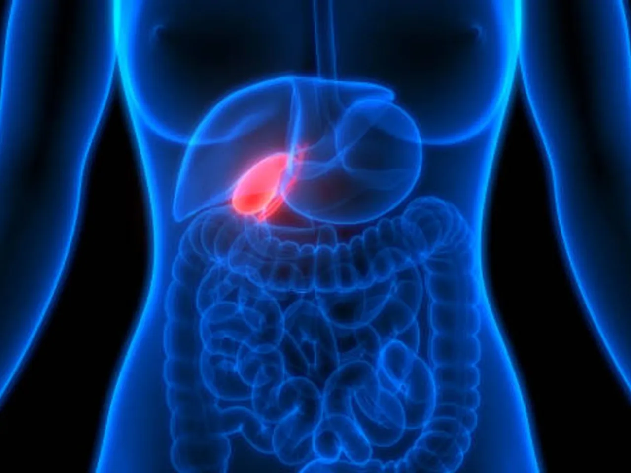 gallstones