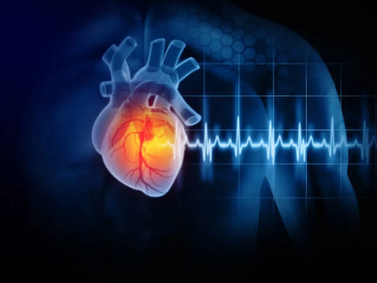 heart attack
