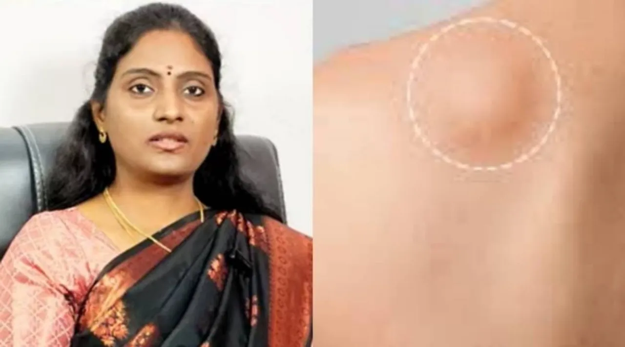 Dr Nithya Lipoma x