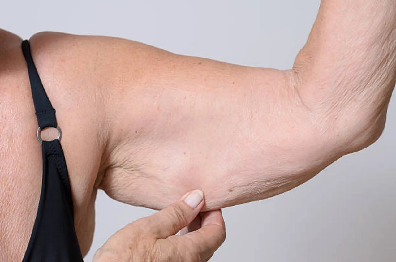 arm fat