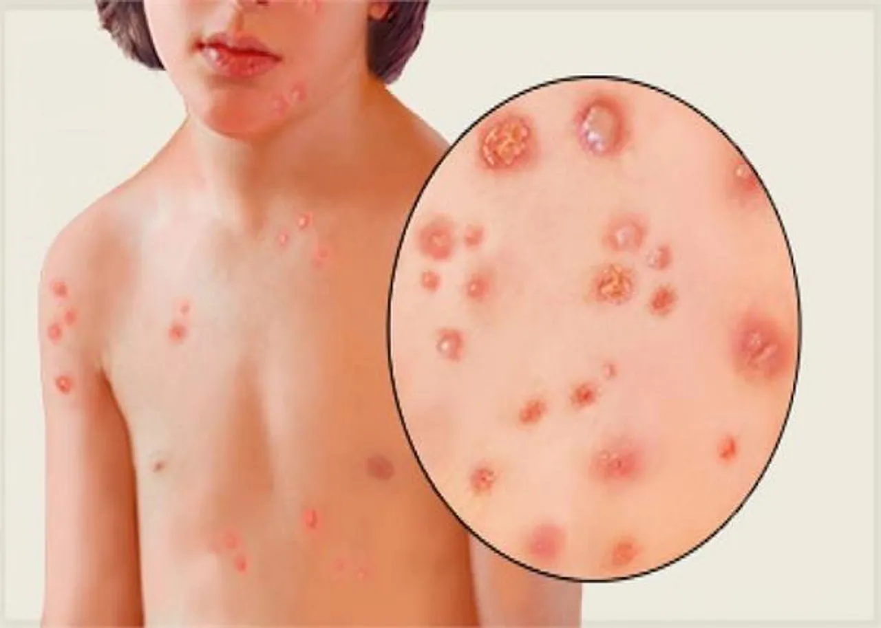 Chicken Pox in Children: Treatment and Prevention