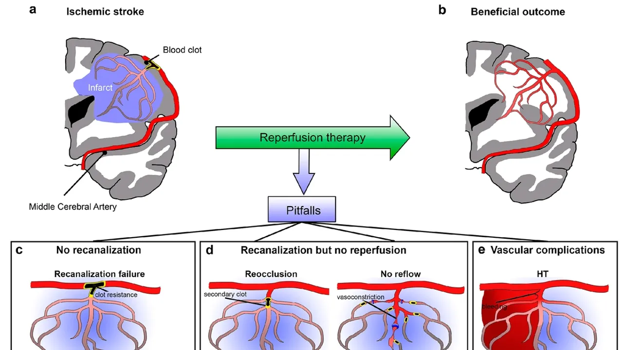 Revolutionizing Stroke Recovery: The Critical Role of Arterial Connections