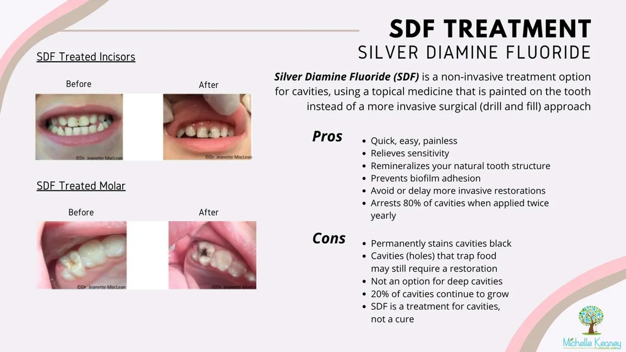 Revolutionizing Pediatric Dentistry: Silver Diamine Fluoride Matches Sealants in Cavity Prevention