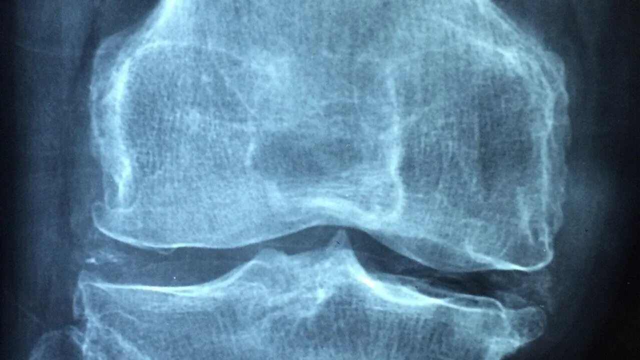 Groundbreaking Study Uncovers How Calcium Crystals in Knees Accelerate Arthritis Progression