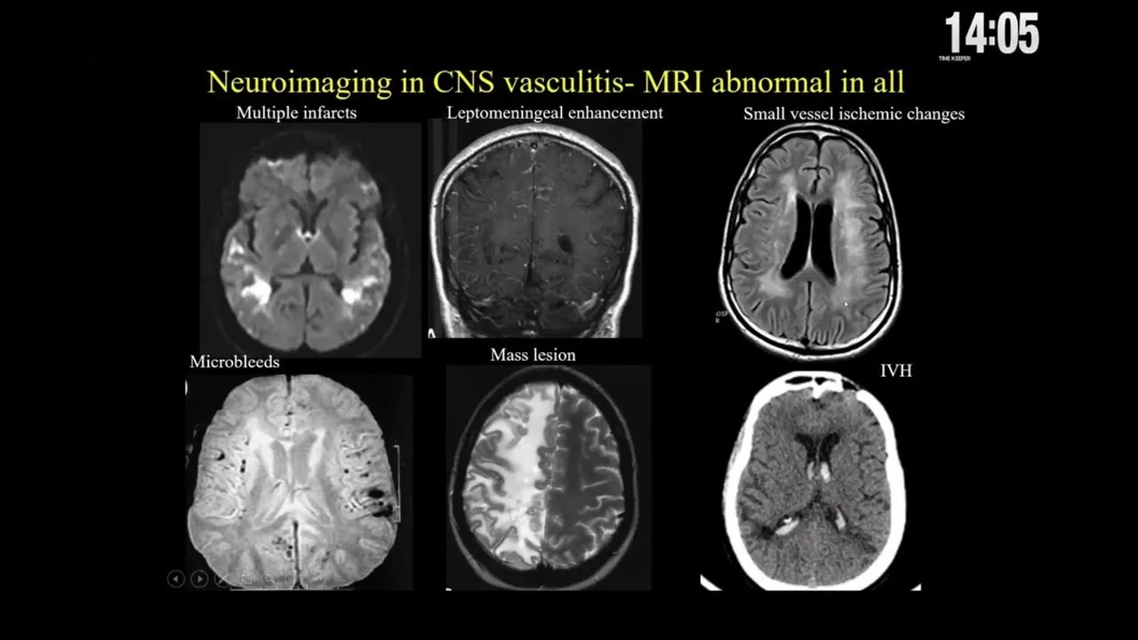 Pioneering Study in India Unravels the Complexities of Brain Vasculitis, Paving the Way for Enhanced Diagnosis