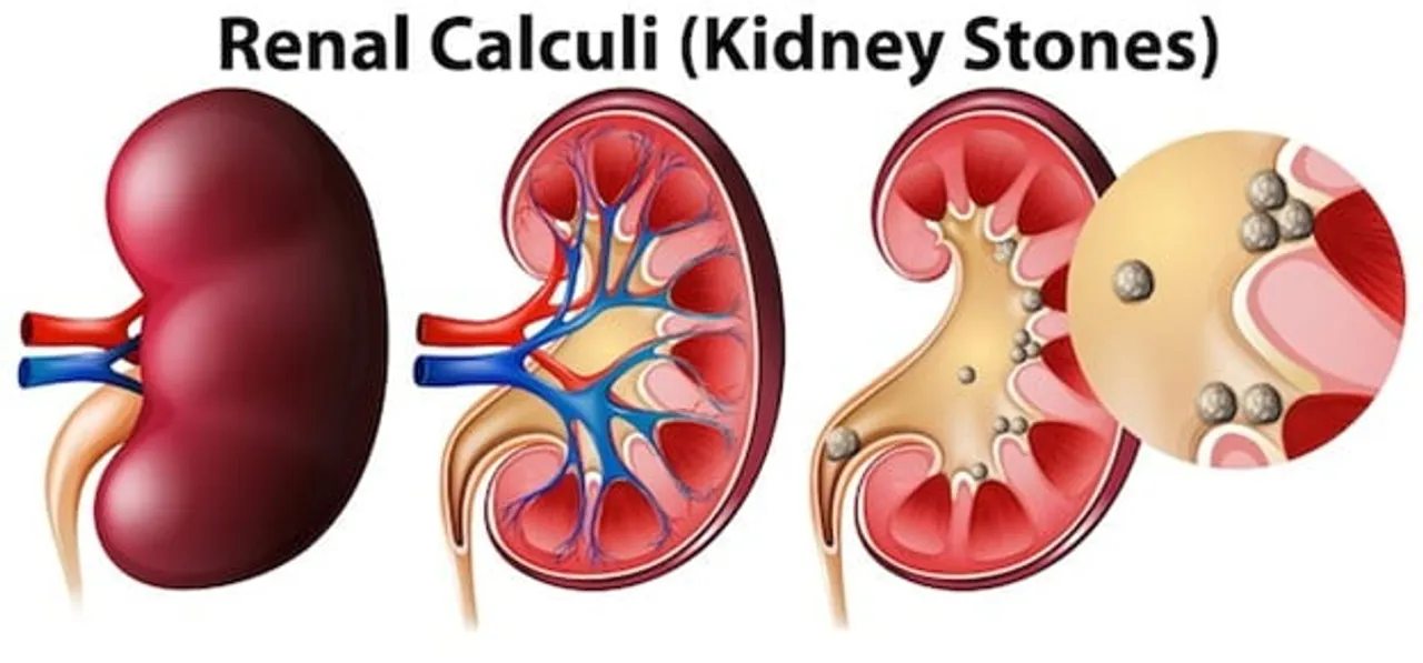 Battle of the Stones: The Comprehensive Guide to Dodging Kidney Stones