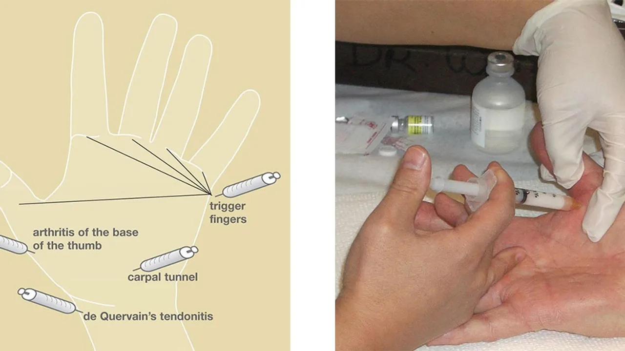 Understanding Hand Osteoarthritis Treatment Options and Their Effectiveness