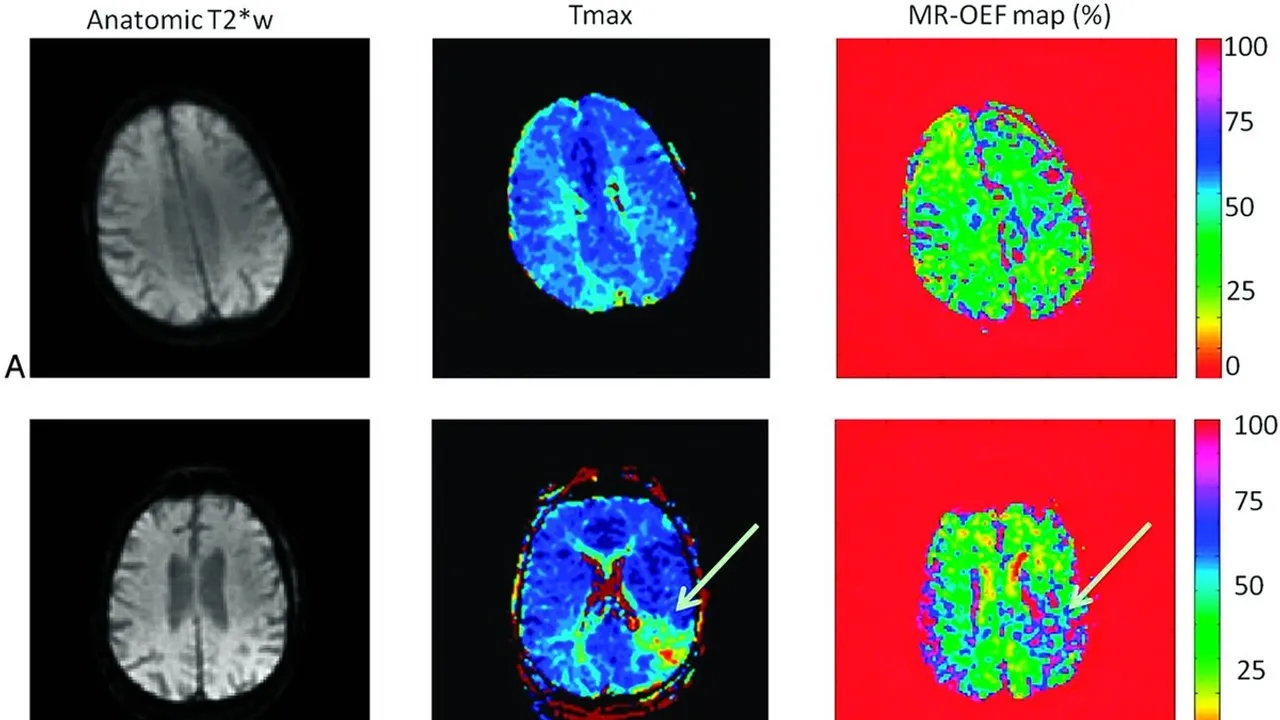 Understanding Brain Oxygenation A Pathway to Neurological Resilience