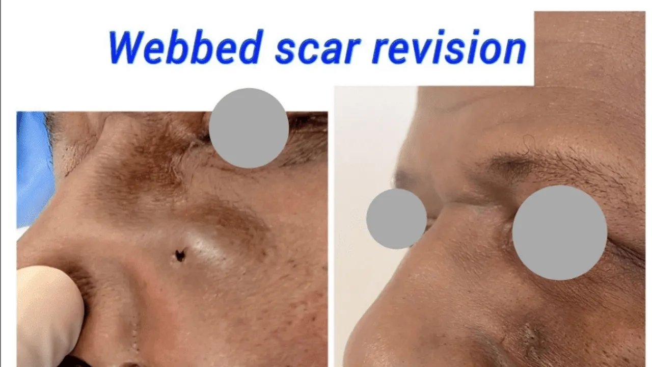 A Comprehensive Guide to Scar Revision Options, Costs, and Effectiveness
