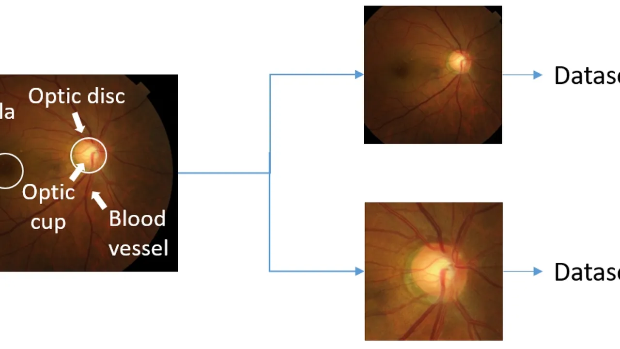 The Future of Optic Disc Abnormalities Classification A Deep Learning