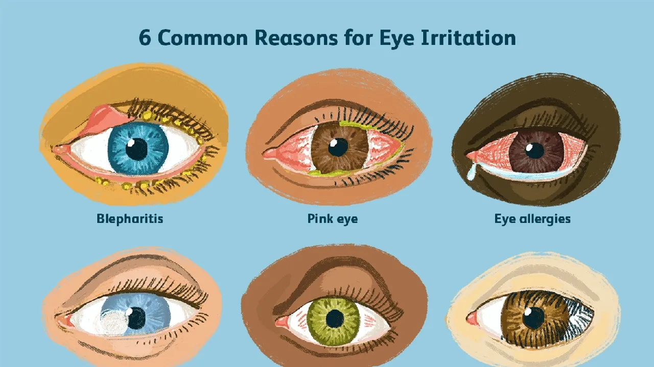 Understanding the Causes of Watery Eyes: Beyond Allergies