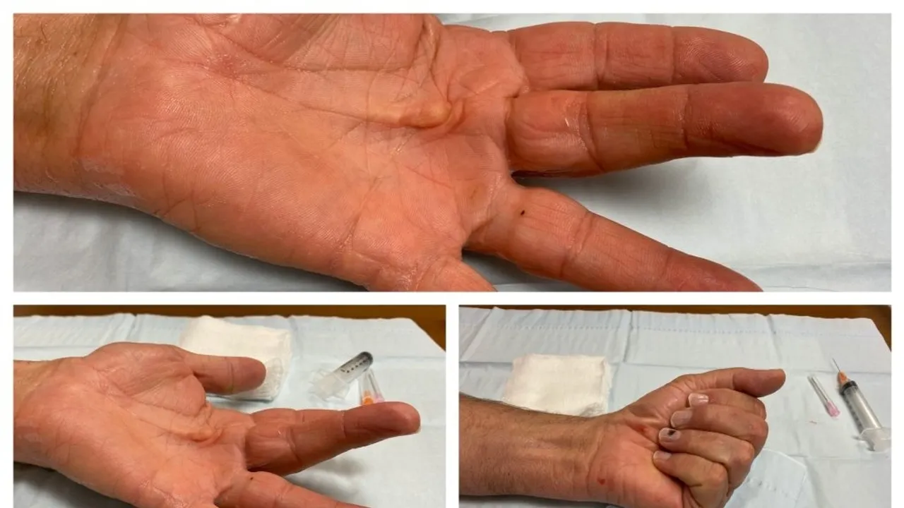Comparing Treatments for Dupuytren Contracture A Closer Look at