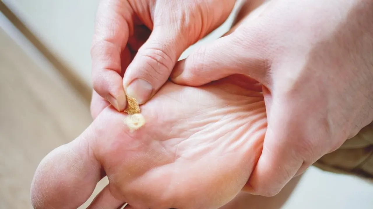 Understanding Warts: Causes, Home Remedies, and Prevention